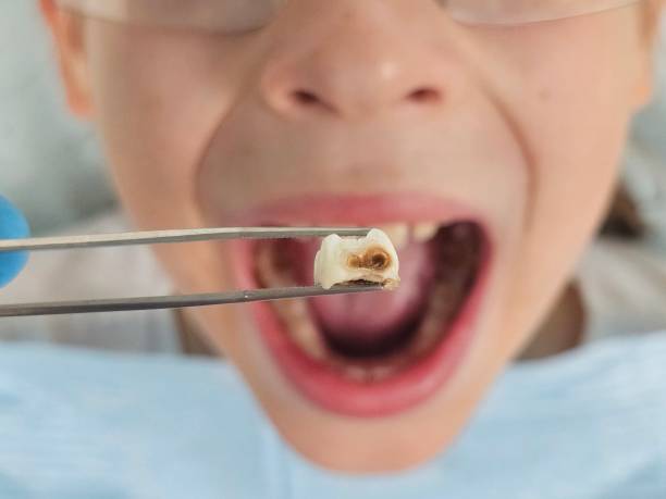Best Emergency Treatment for Dental Infections or Abscesses in Westport Village, CT